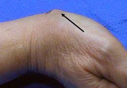 Surgical Photos Of Ganglion Cysts