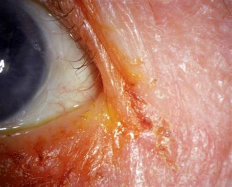 Blepharitis Causes Signs And Symptoms Home Remedies And Treatment