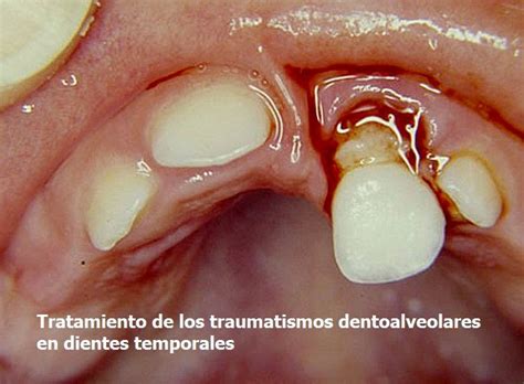 Traumatismos Dentoalveolares Tratamiento En Dientes Temporales