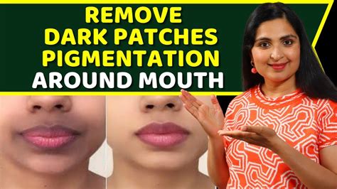 Get Rid Of Dark Black Patches Dark Upper Lips Darkness Around Mouth