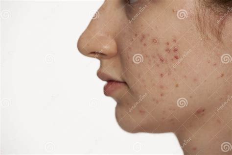 Profile Of Teenage Girl With Problematic Skin Stock Photo Image Of