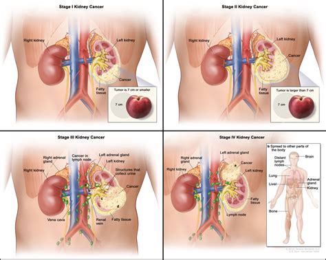 Renal Cell Carcinoma Cancer Queries