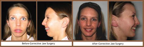 Jaw surgery is strictly considered through your medical coverage. Check this out about Orthognathic Surgery Insurance Coverage