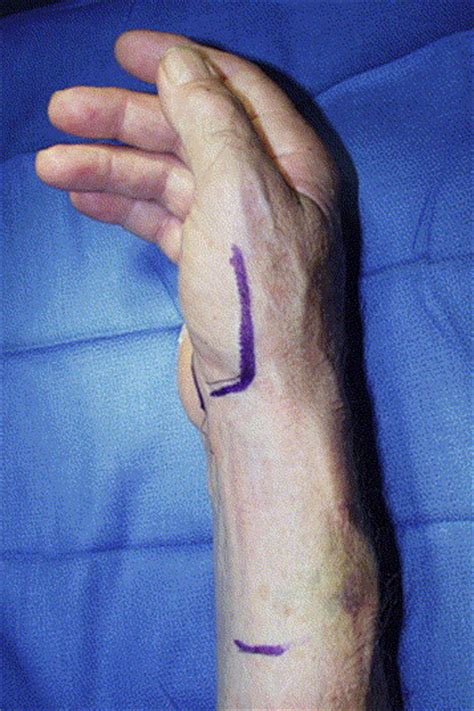 Suture Anchor Arthroplasty For Thumb Carpometacarpal Osteoarthritis