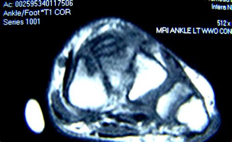 Aneurysmal Bone Cyst Of The Middle Cuneiform A Case Report The Foot