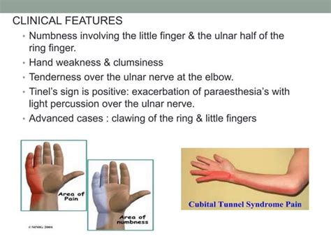 Entrapment Neuropathy Of The Upper Limb Ppt