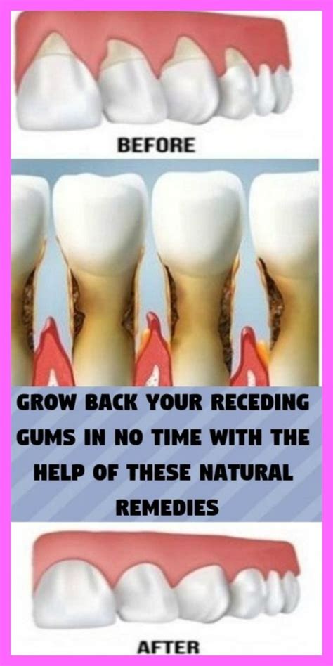 Grow Back Your Receding Gums In No Time With The Help Of These Natural