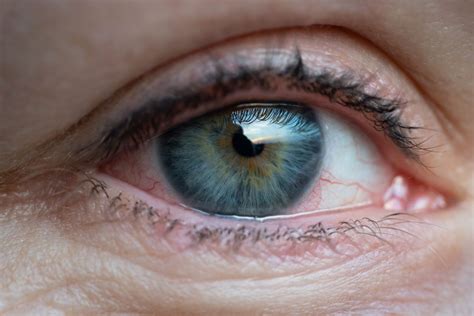 Синдром сухого глаза причины сухости симптомы лечение