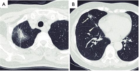 Chest Computed Tomography Ct Shows Three Nodules In The Right Lung