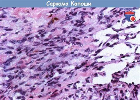 Гистология саркомы Капоши (СК) Картинка - Гистология саркомы Капоши (СК)