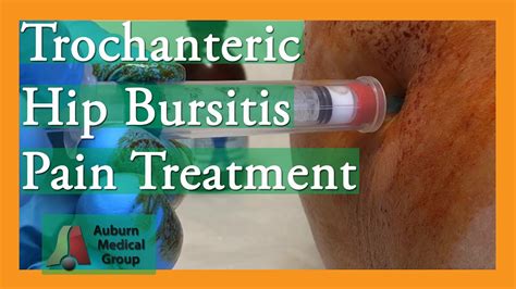 Hip Pain Trochanteric Bursitis Treatment