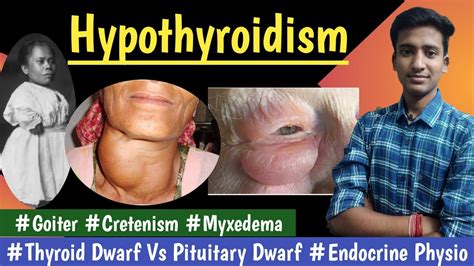 Hypothyroidismgoitercretenismthyroid Dwarf Vs Pituitary Dwarf