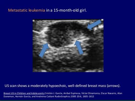 Ultrasound Of Pediatric And Adolescent Breast