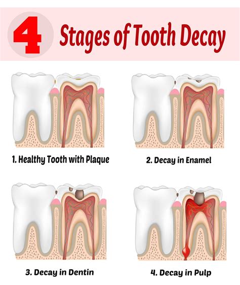 Understand Four Stages Of Tooth Decay And How Cavities Are Caused