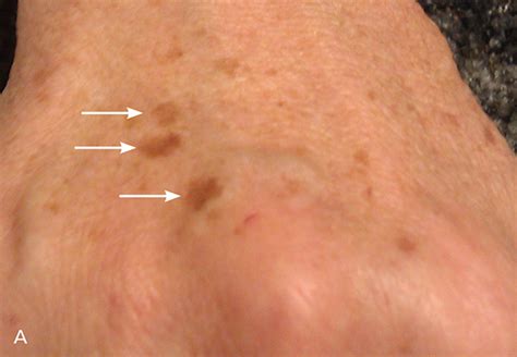 Pigmentation Disorders Diagnosis And Management Aafp