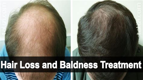 Hair Loss And Baldness Treatment At Home With Honey And Egg Yolk Bald