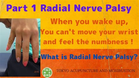 Part 1 Radial Nerve Palsy Wrist Drop What Is Radial Nerve Palsy