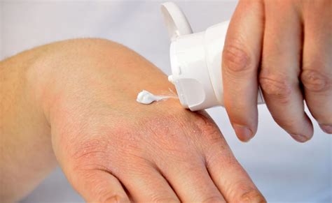 Pac‐14028 Cream Safe Effective For Mild To Moderate Atopic Dermatitis