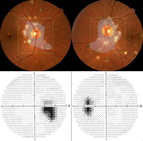 Photoreceptor Outer Segment Abnormalities As A Cause Of Blind Spot