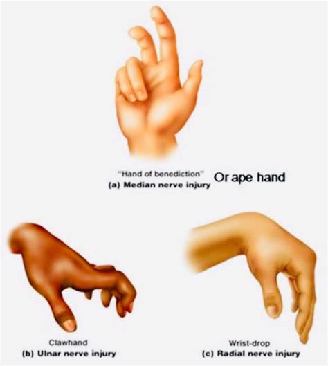 Hand Nerve Injuries Mnemonic Medizzy