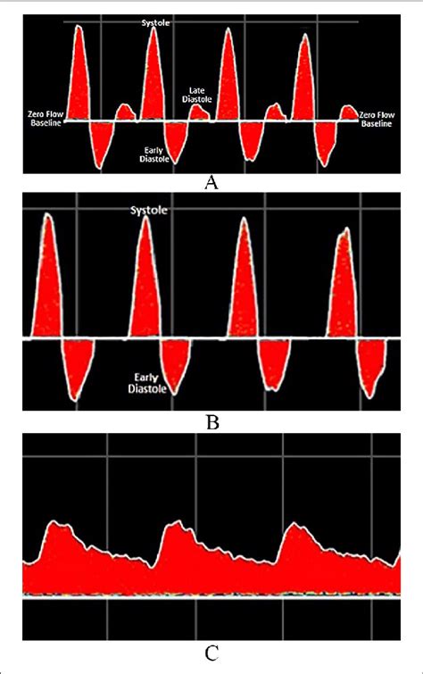 Triphasic A Biphasic B And Monophasic C Doppler Waveforms