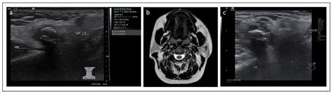 Jcm Free Full Text Calcification In Salivary Gland Cancer Mimicking