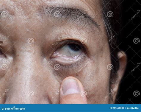 Pale Skin Of Asian Woman Sign Of Anemia Pallor At Eyelid Stock Photo