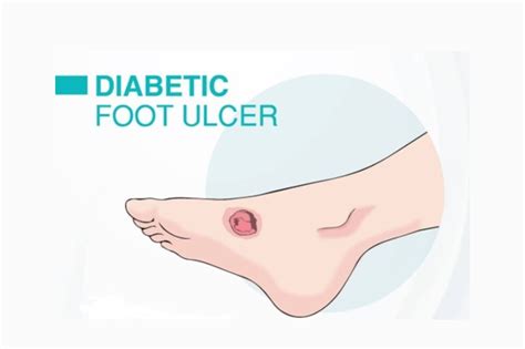 Diabetic Foot Care Easy Steps To The Healthier Foot