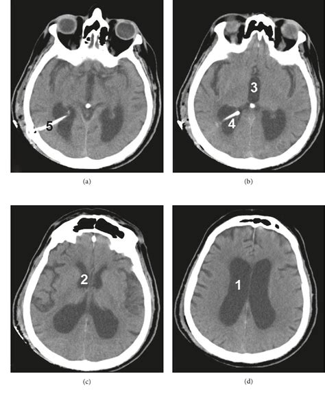 Figure 1 From Delayed Intraventricular Hemorrhage Following A Ventriculoperitoneal Shunt