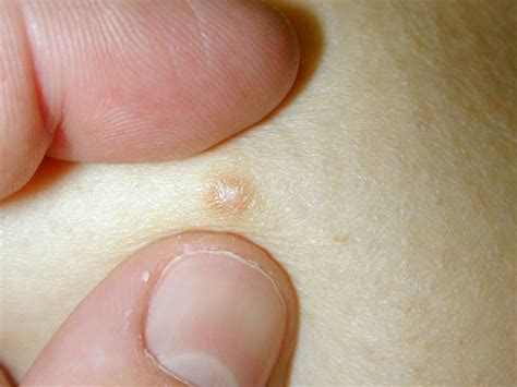 Dermatofibroma Treatment Pictures Removal Causes