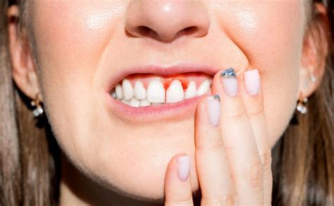 What Does Gum Disease Look Like Peel Dental Studio Dentist Mandurah