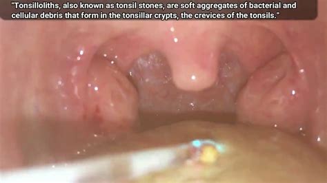 Most Popular Tonsil Stones And Biggest Blackheads Removal Tools Youtube