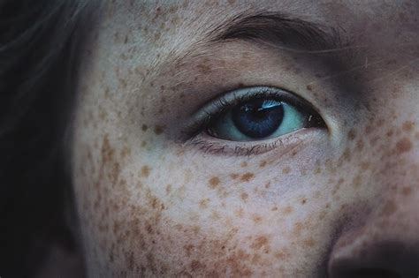 Freckles Why They Occur And Ways Of Concealing Them