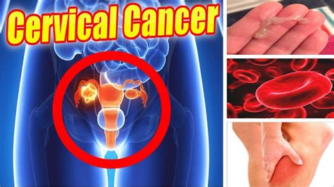 6 Warning Signs Of Cervical Cancer You Must Know Naturalremedies Youtube