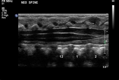 Neonatal Spine Normal Ultrasoundpaedia Neonatal Sonography Ultrasound