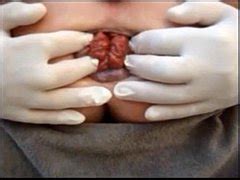 Close Up Anal Ass Anus Dilation Prolapse Xxx Mobile Porno Videos