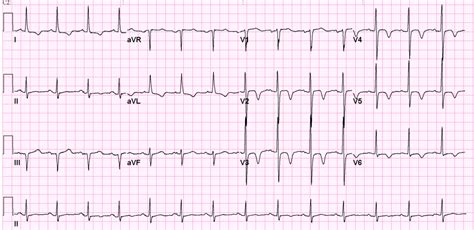 Fileecg Sabpng Ecgpedia