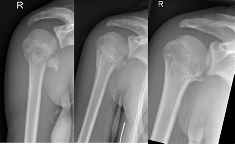 Case Report Of A Proximal Humeral Fracture With An Avulsion Fracture Of