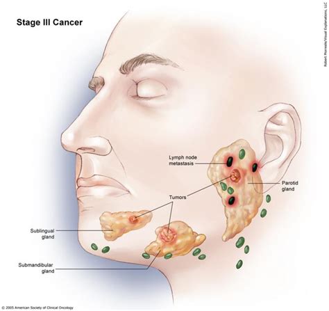 Salivary Gland Cancer Stages And Grades Cancernet