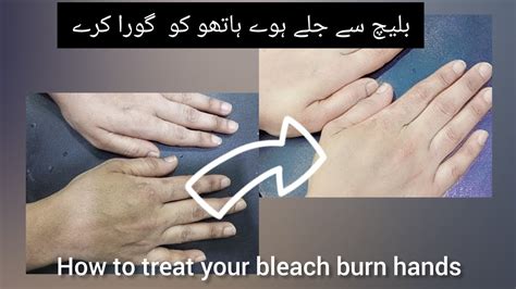 How To Treat Terrible Bleach Chemical Burn On Hands While Skin