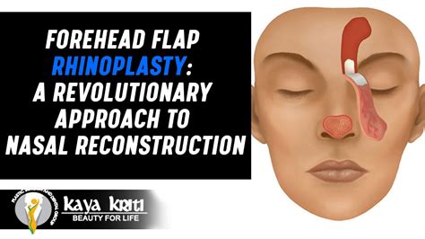 Paramedian Forehead Flap Expert Nasal Defect Reconstruction By Dr