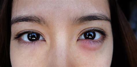 Reasons Why Your Eyelids Are Swollen — Healthy Builderz