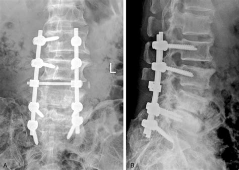 Broken Spine X Ray