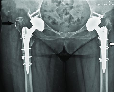 X Ray Radiography Of Patient Whose Trochanter Major Fracture Black