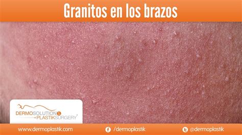 Dermoplastik Granitos En Los Brazos Youtube