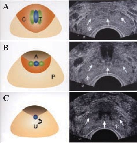 Ultrasound Prostate Anatomy Apex