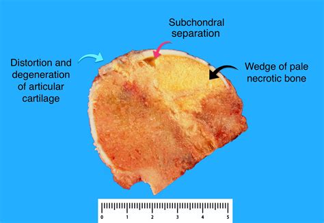 Pathology Outlines Avascular Necrosis