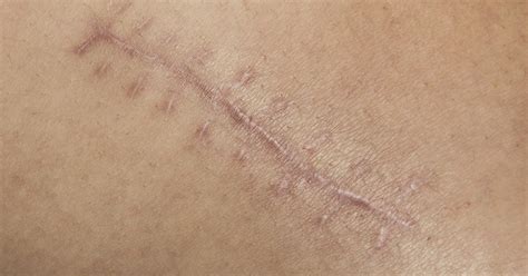 How To Heal Old Scars From The Inside Out Livestrongcom
