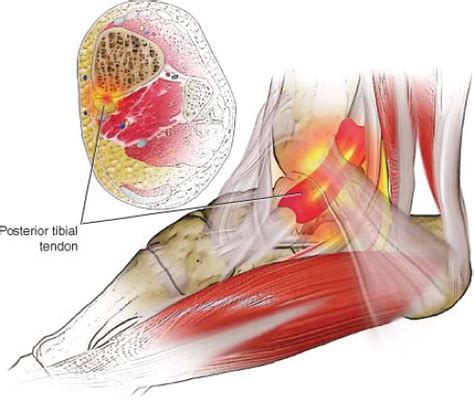 Posterior Tibial Artery Ultrasound Hot Sex Picture