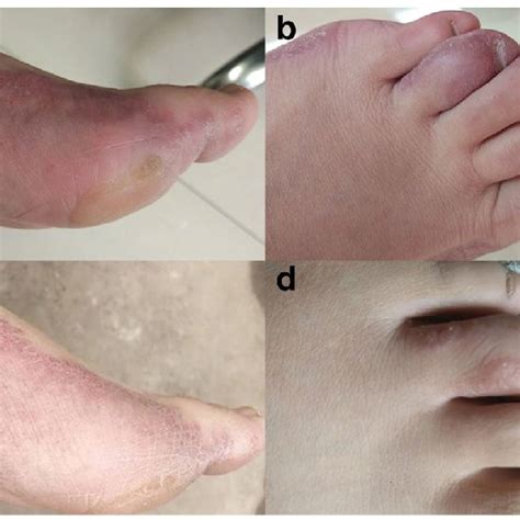 A B Sole Of Left Foot Exhibits Erythema Papules Nodules And